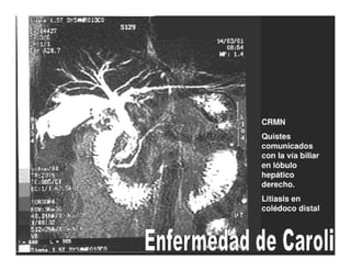 Tumores Vía Biliar