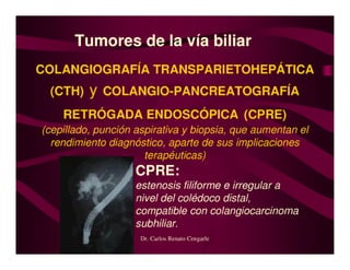 Tumores Vía Biliar