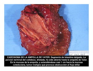 Tumores Vía Biliar