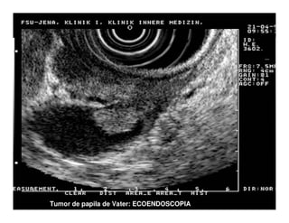 Tumores Vía Biliar