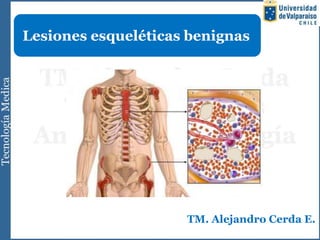 Lesiones esqueléticas benignas




                     TM. Alejandro Cerda E.
 