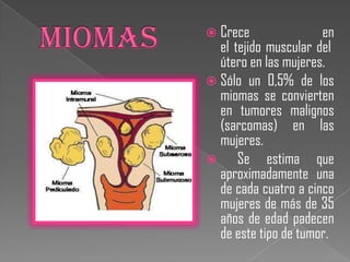  Crece               en
  el tejido muscular del
  útero en las mujeres.
 Sólo un 0,5% de los
  miomas se convierten
  en tumores malignos
  (sarcomas) en las
  mujeres.
     Se estima que
  aproximadamente una
  de cada cuatro a cinco
  mujeres de más de 35
  años de edad padecen
  de este tipo de tumor.
 
