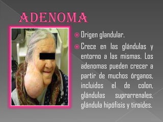  Origen glandular.
 Crece   en las glándulas y
  entorno a las mismas. Los
  adenomas pueden crecer a
  partir de muchos órganos,
  incluidos el de colon,
  glándulas suprarrenales,
  glándula hipófisis y tiroides.
 
