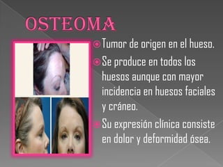 Tumor de origen en el hueso.
 Se produce en todos los
  huesos aunque con mayor
  incidencia en huesos faciales
  y cráneo.
 Su expresión clínica consiste
  en dolor y deformidad ósea.
 