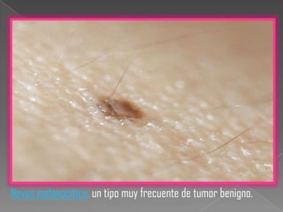Nevus melanocítico, un tipo muy frecuente de tumor benigno.
 