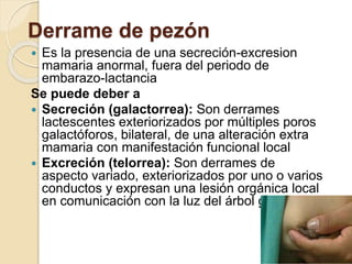 Derrame de pezón
 Es la presencia de una secreción-excresion
mamaria anormal, fuera del periodo de
embarazo-lactancia
Se puede deber a
 Secreción (galactorrea): Son derrames
lactescentes exteriorizados por múltiples poros
galactóforos, bilateral, de una alteración extra
mamaria con manifestación funcional local
 Excreción (telorrea): Son derrames de
aspecto variado, exteriorizados por uno o varios
conductos y expresan una lesión orgánica local
en comunicación con la luz del árbol galactóforo
 