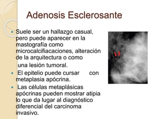 Adenosis Esclerosante
 Suele ser un hallazgo casual,
pero puede aparecer en la
mastografía como
microcalcifiacaciones, alteración
de la arquitectura o como
una lesión tumoral.
 El epitelio puede cursar con
metaplasia apócrina.
 Las células metaplásicas
apócrinas pueden mostrar atipia
lo que da lugar al diagnóstico
diferencial del carcinoma
invasivo.
 