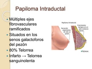 Papiloma Intraductal
 Múltiples ejes
fibrovasculares
ramificados
 Situados en los
senos galactoforos
del pezón
 80% Telorrea
 Infarto → Telorrea
sanguinolenta
 