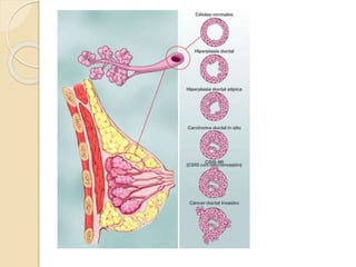 Tumores benignos de la mama
