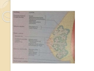 Tumores benignos de la mama