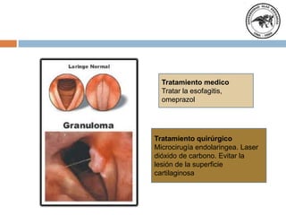 Tratamiento medico
Tratar la esofagitis,
omeprazol

Tratamiento quirúrgico
Microcirugía endolaringea. Laser
dióxido de carbono. Evitar la
lesión de la superficie
cartilaginosa

 