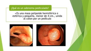 •Es una masa polipoide hemisférica o
esférica y pequeña, menor de 4 cm., unida
al colon por un pedículo
¿Qué es un adenoma pediculado?
 