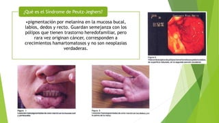 •pigmentación por melanina en la mucosa bucal,
labios, dedos y recto. Guardan semejanza con los
pólipos que tienen trastorno heredofamiliar, pero
rara vez originan cáncer, corresponden a
crecimientos hamartomatosos y no son neoplasias
verdaderas.
¿Qué es el Síndrome de Peutz-Jeghers?
 