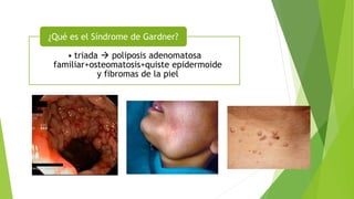 • triada  poliposis adenomatosa
familiar+osteomatosis+quiste epidermoide
y fibromas de la piel
¿Qué es el Síndrome de Gardner?
 