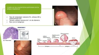 • Tasa de malignidad: tubulares 5%, vellosos 40% y
tubulovellosos 22%
• Tamaño: pólipos menores de 1 cm de diámetro
• Rara vez se malignizan
¿Cuáles son las características particulares de los
pólipos neoplásicos?
 