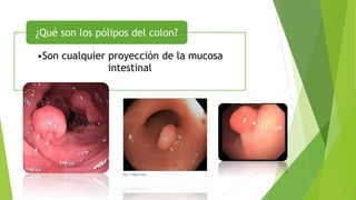 •Son cualquier proyección de la mucosa
intestinal
¿Qué son los pólipos del colon?
 