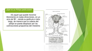 •Es aquel que puede moverse
libremente en todas direcciones, en un
arco de 90°, siendo su pedículo o tallo
largo, de manera que la cabeza del
pólipo se pueda desplazar por las
contracciones propulsivas del intestino
¿Qué es un Pólipo pediculado?
 