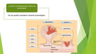 •Se les puede considerar lesiones premalignas
¿ cual es la importancia clínica de
los pólipos?
 