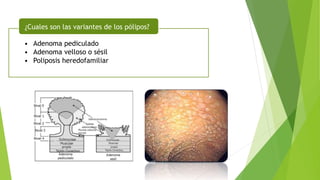 • Adenoma pediculado
• Adenoma velloso o sésil
• Poliposis heredofamiliar
¿Cuales son las variantes de los pólipos?
 