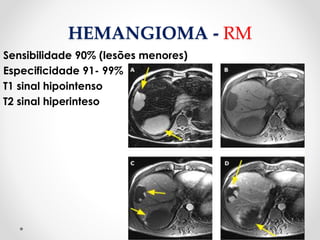 HEMANGIOMA - RM
Sensibilidade 90% (lesões menores)
Especificidade 91- 99%
T1 sinal hipointenso
T2 sinal hiperinteso
 