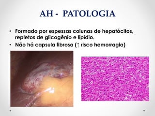 AH - PATOLOGIA
• Formado por espessas colunas de hepatócitos,
repletos de glicogênio e lipídio.
• Não há capsula fibrosa (↑ risco hemorragia)
 
