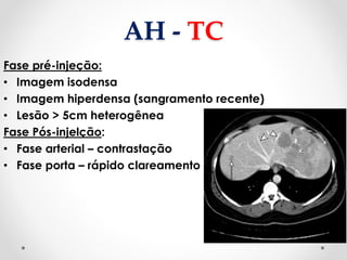 AH - TC
Fase pré-injeção:
• Imagem isodensa
• Imagem hiperdensa (sangramento recente)
• Lesão > 5cm heterogênea
Fase Pós-injelção:
• Fase arterial – contrastação
• Fase porta – rápido clareamento
 