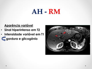 AH - RM
Aparência variável
• Sinal hiperintenso em T2
• Intensidade variável em T1
gordura e glicogênio
 