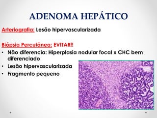 ADENOMA HEPÁTICO
Arteriografia: Lesão hipervascularizada
Biópsia Percutãnea: EVITAR!!
• Não diferencia: Hiperplasia nodular focal x CHC bem
diferenciado
• Lesão hipervascularizada
• Fragmento pequeno
 