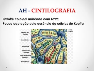 AH - CINTILOGRAFIA
Enxofre coloidal marcado com Tc99:
Pouca captação pela ausência de células de Kupffer
 