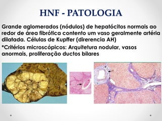HNF - PATOLOGIA
Grande aglomerados (nódulos) de hepatócitos normais ao
redor de área fibrótica contento um vaso geralmente artéria
dilatada. Células de Kupffer (direrencia AH)
*Critérios microscópicos: Arquitetura nodular, vasos
anormais, proliferação ductos bilares
 