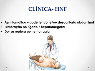 CLÍNICA- HNF
• Assintomático – pode ter dor e/ou desconforto abdominal
• Tumoração no fígado / hepatomegalia
• Dor se ruptura ou hemorragia
 