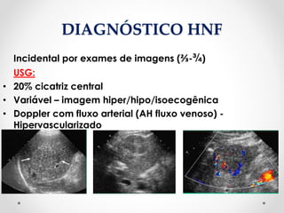 DIAGNÓSTICO HNF
Incidental por exames de imagens (⅔-¾)
USG:
• 20% cicatriz central
• Variável – imagem hiper/hipo/isoecogênica
• Doppler com fluxo arterial (AH fluxo venoso) -
Hipervascularizado
 