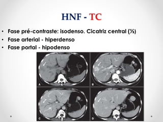 HNF - TC
• Fase pré-contraste: isodenso. Cicatriz central (⅓)
• Fase arterial - hiperdenso
• Fase portal - hipodenso
 