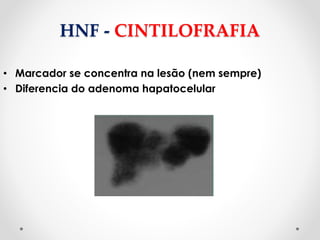 HNF - CINTILOFRAFIA
• Marcador se concentra na lesão (nem sempre)
• Diferencia do adenoma hapatocelular
 