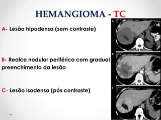 HEMANGIOMA - TC
A- Lesão hipodensa (sem contraste)
B- Realce nodular periférico com gradual
preenchimento da lesão
C- Lesão isodensa (pós contraste)
 