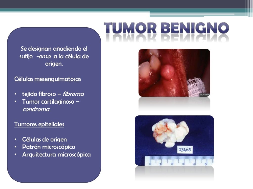Tumores benignos y malignos