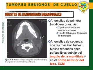 FACULTADDEMEDICINA
T U M O R E S B E N I G N O S D E C U E L L O
QUISTES DE HENDIDURAS BRANQUIALES
Anomalías de primera
hendidura branquial:
Tipo I: duplicación del
conducto externo
Tipo II: debajo del ángulo de
la mandíbula
Anomalías de segunda:
son las más habituales.
Masas redondas poco
perceptibles debajo del
ángulo de la mandilula y
en el borde anterior del
Msc. ECM
 