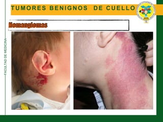 FACULTADDEMEDICINA
T U M O R E S B E N I G N O S D E C U E L L O
Hemangiomas
 