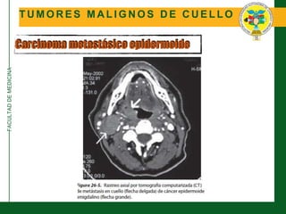 FACULTADDEMEDICINA
T U M O R E S M A L I G N O S D E C U E L L O
Carcinoma metastásico epidermoide
 