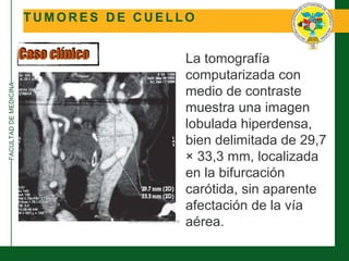 FACULTADDEMEDICINA
T U M O R E S D E C U E L L O
Caso clínico La tomografía
computarizada con
medio de contraste
muestra una imagen
lobulada hiperdensa,
bien delimitada de 29,7
× 33,3 mm, localizada
en la bifurcación
carótida, sin aparente
afectación de la vía
aérea.
 