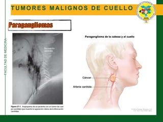 FACULTADDEMEDICINA
T U M O R E S M A L I G N O S D E C U E L L O
Paragangliomas
 