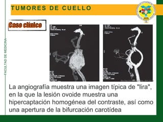 FACULTADDEMEDICINA
T U M O R E S D E C U E L L O
Caso clínico
La angiografía muestra una imagen típica de "lira",
en la que la lesión ovoide muestra una
hipercaptación homogénea del contraste, así como
una apertura de la bifurcación carotídea
 