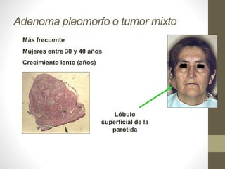 Adenoma pleomorfo o tumor mixto
Más frecuente
Mujeres entre 30 y 40 años
Crecimiento lento (años)
Lóbulo
superficial de la
parótida
 