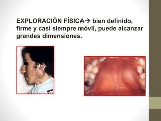 EXPLORACIÓN FÍSICA bien definido,
firme y casi siempre móvil, puede alcanzar
grandes dimensiones.
 