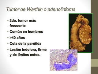 Tumor de Warthin o adenolinfoma
• 2do. tumor más
frecuente
• Común en hombres
• >40 años
• Cola de la parótida
• Lesión indolora, firme
y de límites netos.
 