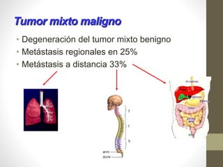Tumor mixto maligno
• Degeneración del tumor mixto benigno
• Metástasis regionales en 25%
• Metástasis a distancia 33%
 