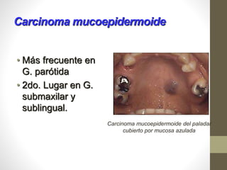 Carcinoma mucoepidermoide
• Más frecuente en
G. parótida
• 2do. Lugar en G.
submaxilar y
sublingual.
Carcinoma mucoepidermoide del paladar
cubierto por mucosa azulada
 