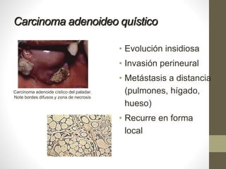 Carcinoma adenoideo quístico
• Evolución insidiosa
• Invasión perineural
• Metástasis a distancia
(pulmones, hígado,
hueso)
• Recurre en forma
local
Carcinoma adenoide cístico del paladar.
Note bordes difusos y zona de necrosis
 