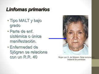 Linfomas primarios
• Tipo MALT y bajo
grado
• Parte de enf.
sistémica o única
manifestación.
• Enfermedad de
Sjögren se relaciona
con un R.R. 40 Mujer con S. de Sjögren. Note tumoración
bilateral de parótidas
 