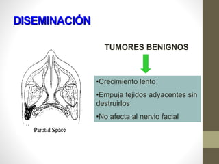 DISEMINACIÓN
TUMORES BENIGNOS
•Crecimiento lento
•Empuja tejidos adyacentes sin
destruirlos
•No afecta al nervio facial
 